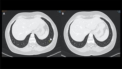 Case report: Pembrolizumab plus Axitinib related hypothyroid myopathy in two kidney cancer patients